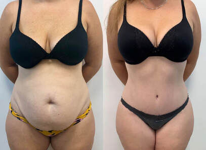 My mommy makeover patient 8 weeks post op after tummy tuck, and