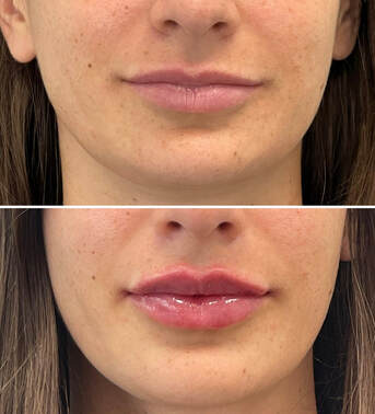 fullips before and after