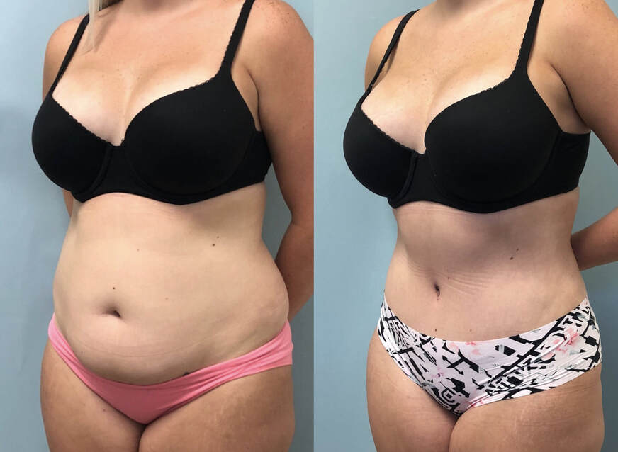 Am I good candidate to have surgery me for a plus size tummy tuck and BBL?  (photos)