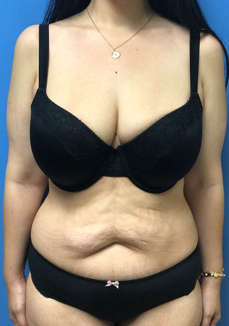8 months post op from tummy tuck with muscle repair and a breast